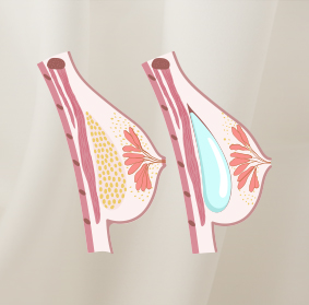 Breast implants vs fat transfer blog 01