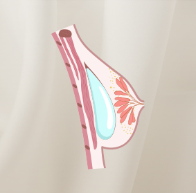 Breast implants placement blog 01
